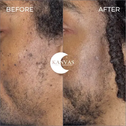 Kanvas Medical Aesthetics result — Indianapolis, IN
