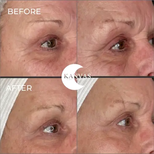Kanvas Medical Aesthetics result — Indianapolis, IN