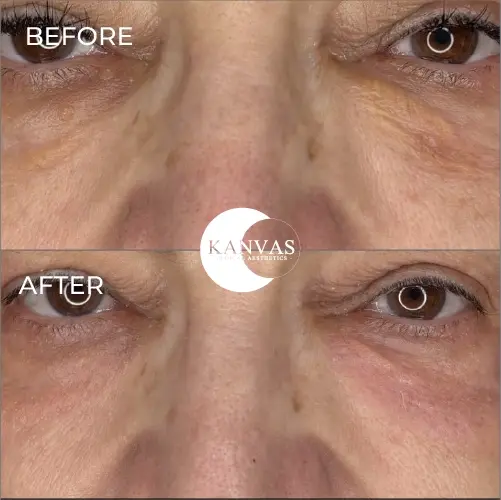 Kanvas Medical Aesthetics result — Indianapolis, IN