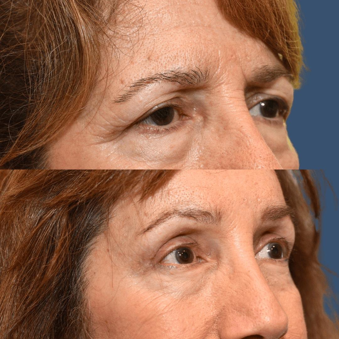 Morgenstern Medical brow lift result — Wayne, PA