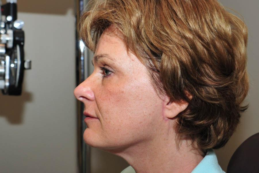 Morgenstern Medical facelift after — Wayne, PA