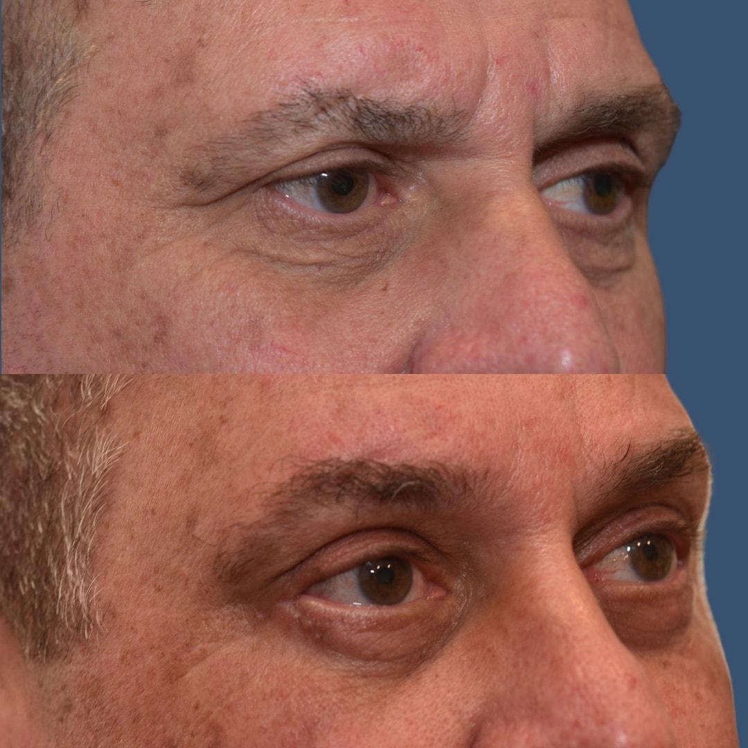 Morgenstern Medical brow lift result — Wayne, PA