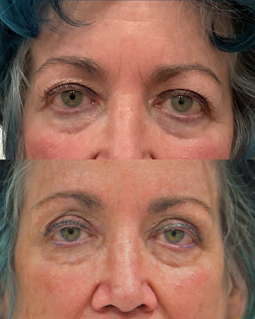 Morgenstern Medical brow lift result — Wayne, PA