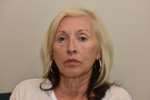 Laser Skin Resurfacing before at Morgenstern Medical in Wayne, PA