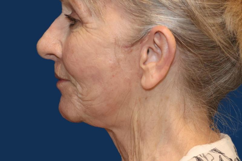Morgenstern Medical facelift after — Wayne, PA