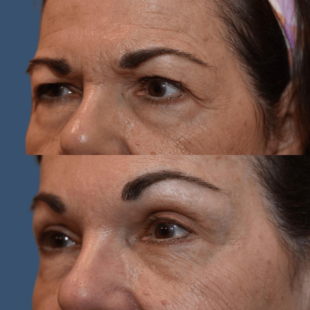 Morgenstern Medical brow lift result — Wayne, PA