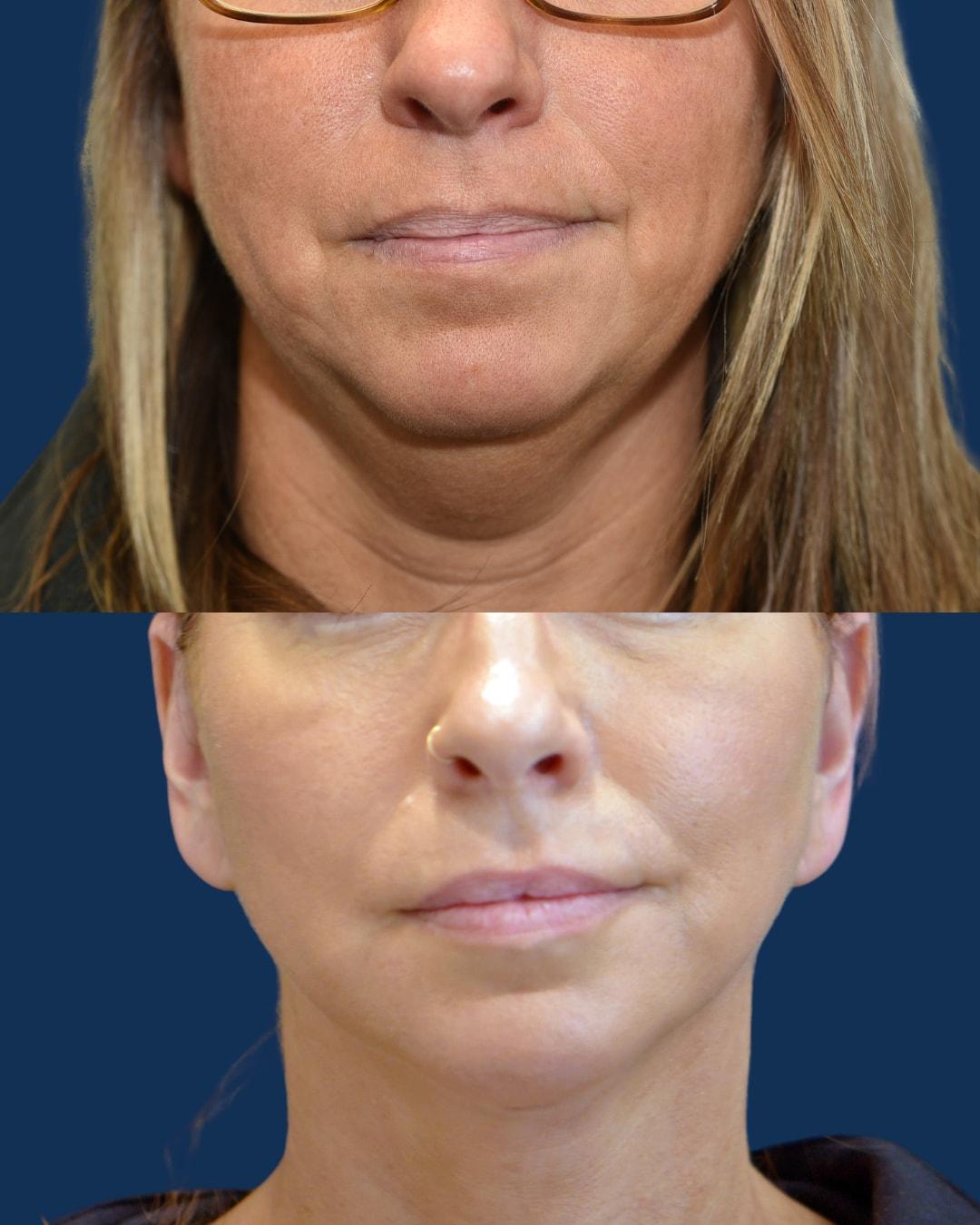 Morgenstern Medical facelift result — Wayne, PA