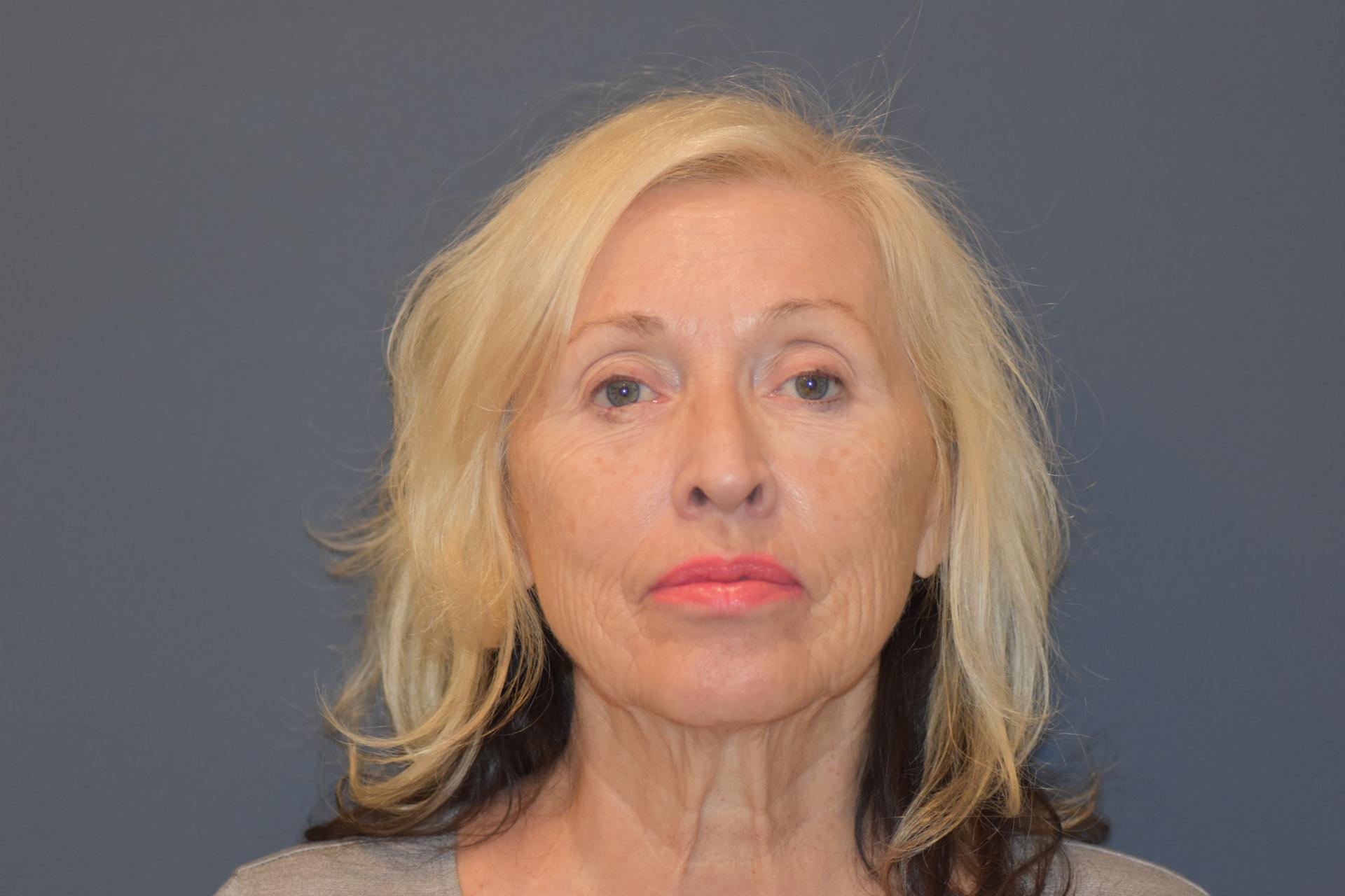 Morgenstern Medical laser treatment after — Wayne, PA