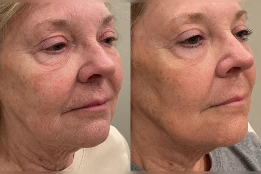 Morgenstern Medical laser treatment result — Wayne, PA
