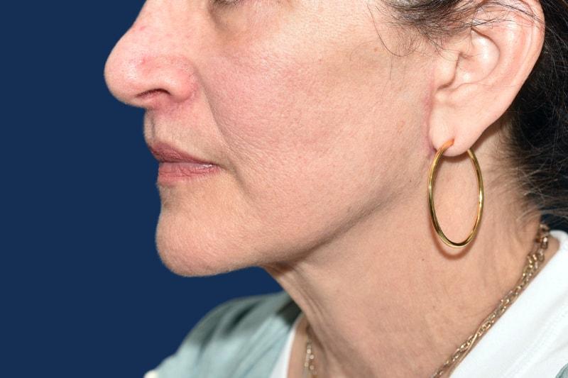 Morgenstern Medical facelift after — Wayne, PA