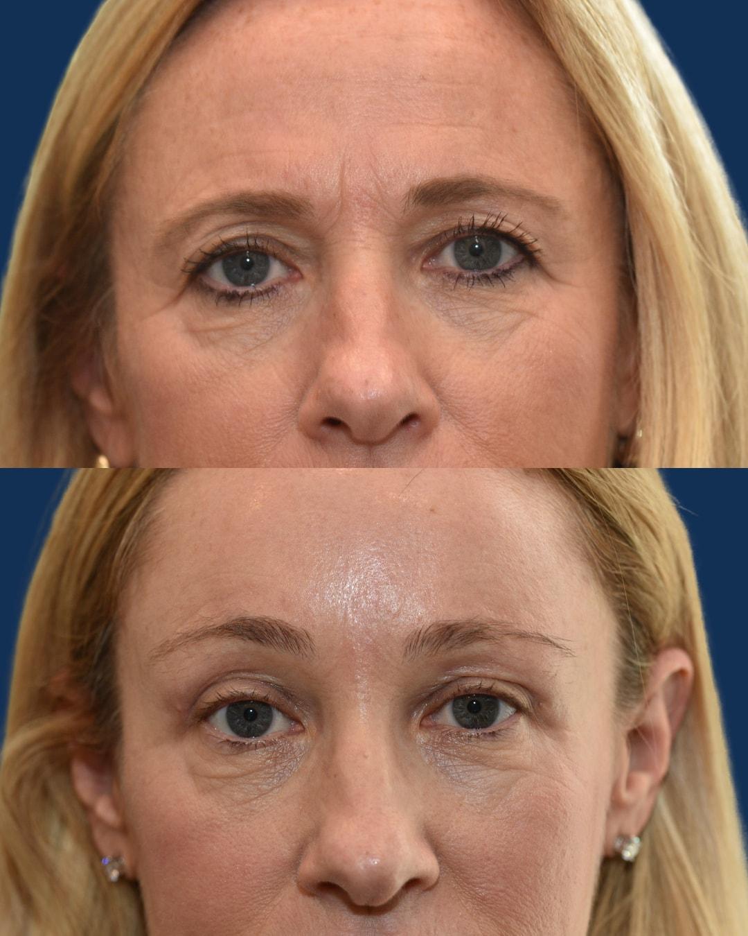 Morgenstern Medical brow lift result — Wayne, PA