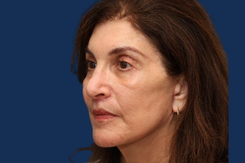 Morgenstern Medical facelift after — Wayne, PA
