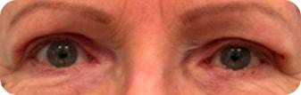 Silkiss Eye Surgery eyelid lift after — Fremont, CA