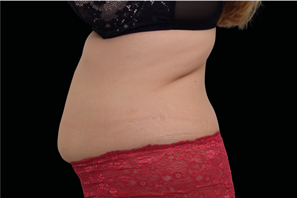 Liposuction before at Jon 'Ric Medical Spa and Wellness Center in Charlotte, NC