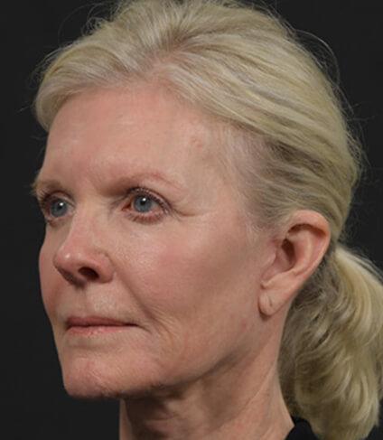 Facelift after at DR. MICHAEL LEE in Dallas, TX