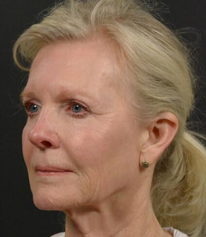 Facelift before at DR. MICHAEL LEE in Dallas, TX