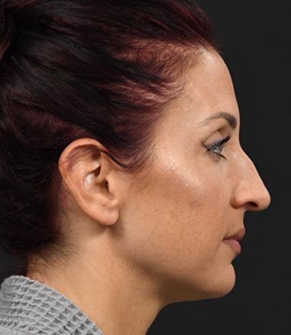 Liquid Rhinoplasty before at DR. MICHAEL LEE in Dallas, TX