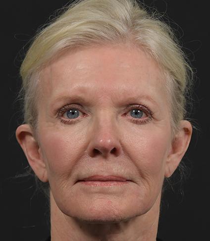Facelift after at DR. MICHAEL LEE in Dallas, TX