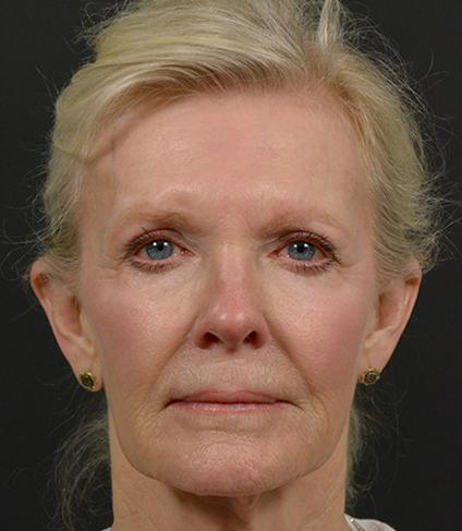 Facelift before at DR. MICHAEL LEE in Dallas, TX