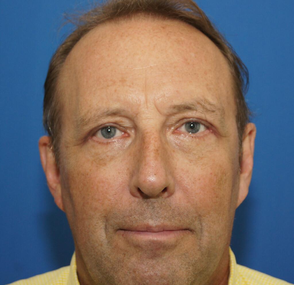 Neal Goldberg, MD blepharoplasty after — Scarsdale, NY