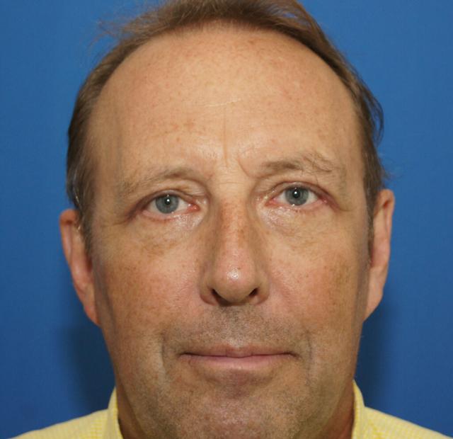 Blepharoplasty after at Neal Goldberg, MD in Scarsdale, NY