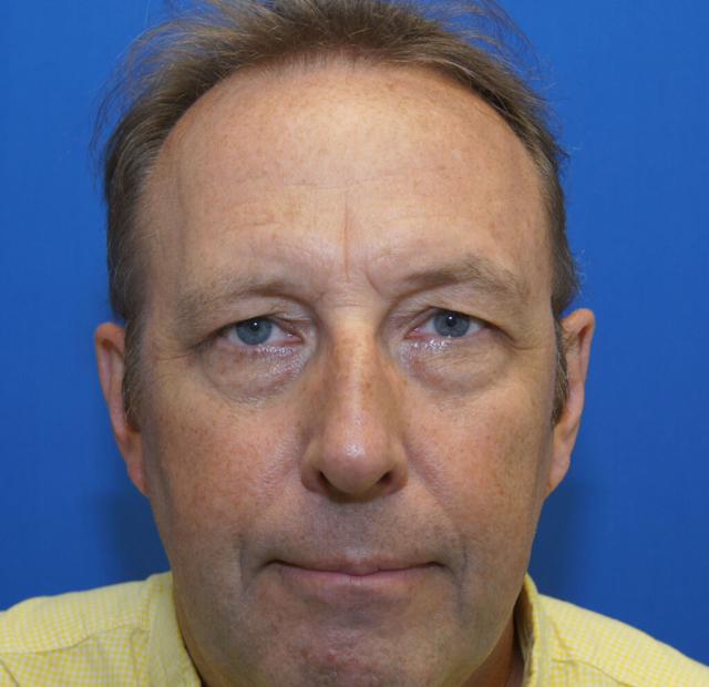 Blepharoplasty before at Neal Goldberg, MD in Scarsdale, NY