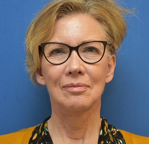 Neck Lift after at Neal Goldberg, MD in Scarsdale, NY