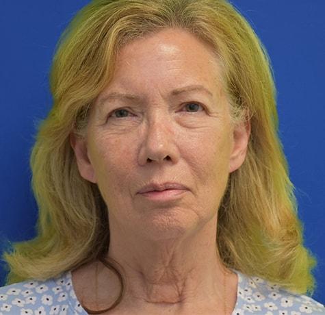 Neck Lift before at Neal Goldberg, MD in Scarsdale, NY