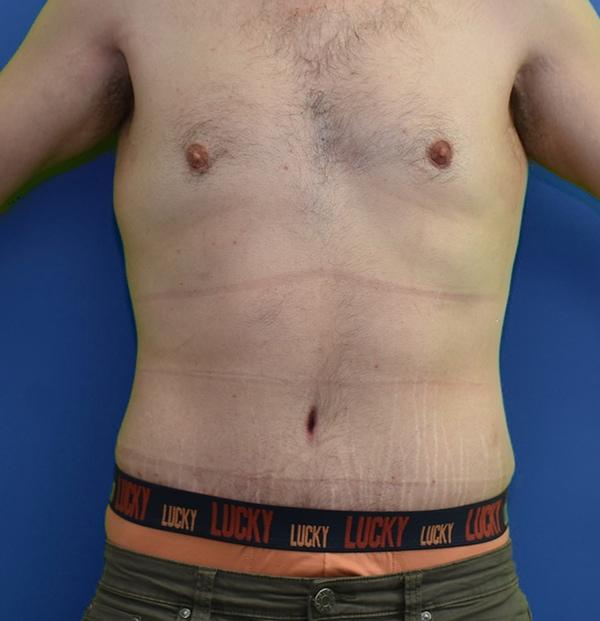Neal Goldberg, MD tummy tuck after — Scarsdale, NY