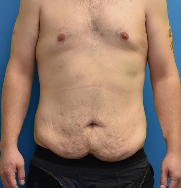 Mommy Makeover before at Neal Goldberg, MD in Scarsdale, NY