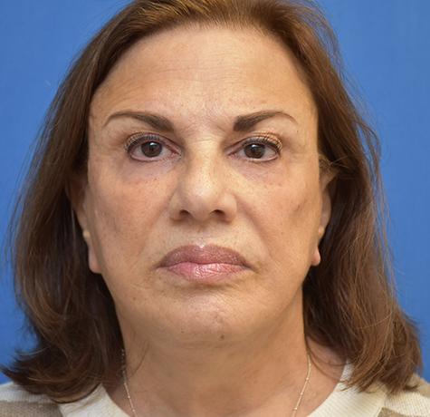 Facelift after at Neal Goldberg, MD in Scarsdale, NY