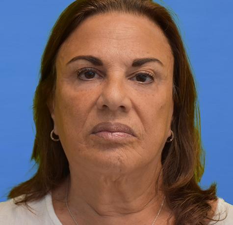 Facelift before at Neal Goldberg, MD in Scarsdale, NY