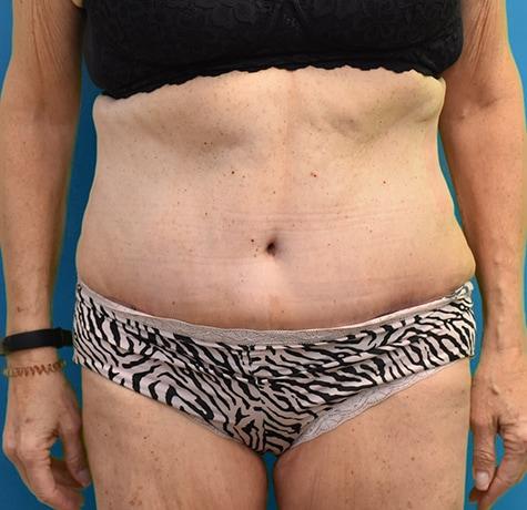 Tummy Tuck after at Neal Goldberg, MD in Scarsdale, NY