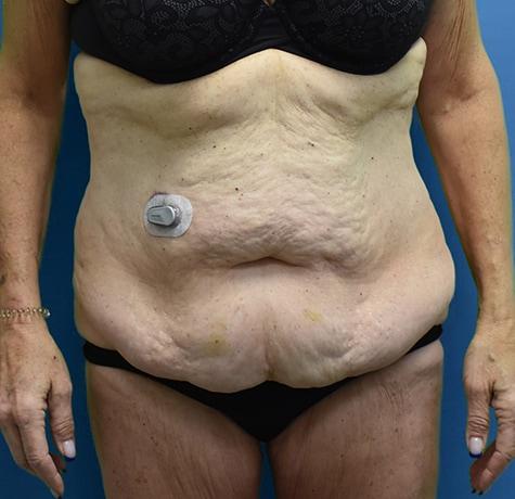 Tummy Tuck before at Neal Goldberg, MD in Scarsdale, NY
