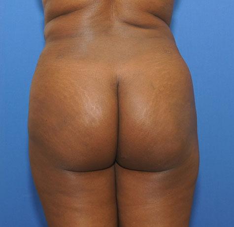 Liquid BBL after at Neal Goldberg, MD in Scarsdale, NY