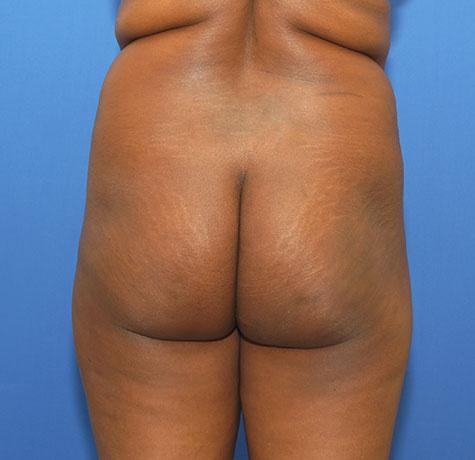 Liquid BBL before at Neal Goldberg, MD in Scarsdale, NY