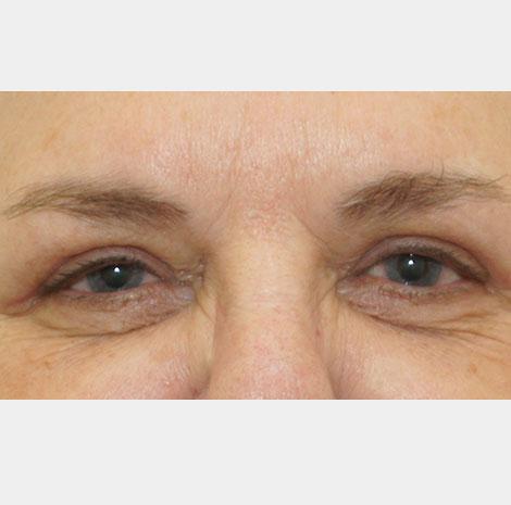 Neal Goldberg, MD brow lift after — Scarsdale, NY
