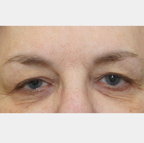 Brow Lift before at Neal Goldberg, MD in Scarsdale, NY