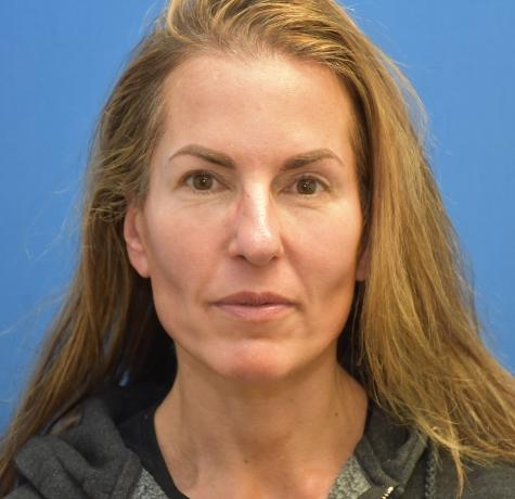 Neck Lift after at Neal Goldberg, MD in Scarsdale, NY