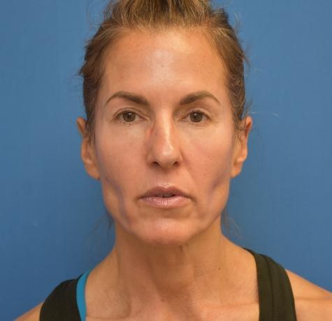 Neck Lift before at Neal Goldberg, MD in Scarsdale, NY