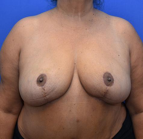 Breast Reduction after at Neal Goldberg, MD in Scarsdale, NY