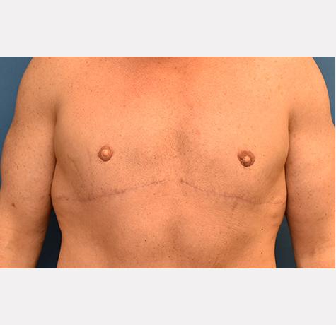 Neal Goldberg, MD gynecomastia after — Scarsdale, NY