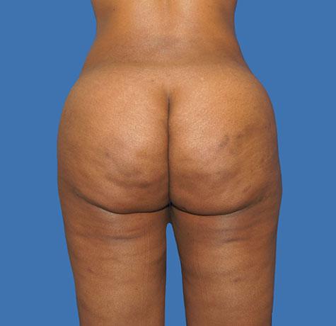 Liquid BBL after at Neal Goldberg, MD in Scarsdale, NY