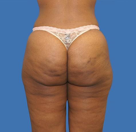 Liquid BBL before at Neal Goldberg, MD in Scarsdale, NY