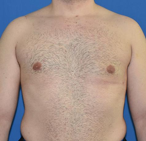 Neal Goldberg, MD gynecomastia after — Scarsdale, NY