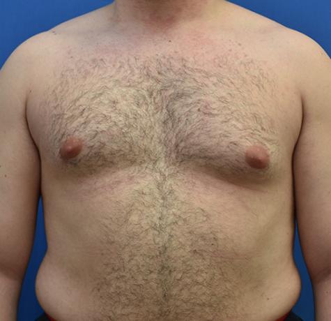 Gynecomastia Surgery before at Neal Goldberg, MD in Scarsdale, NY