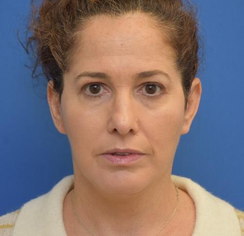 Neal Goldberg, MD facelift after — Scarsdale, NY