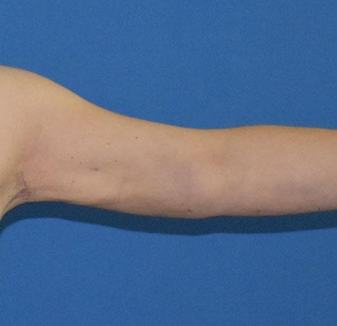 Arm Lift after at Neal Goldberg, MD in Scarsdale, NY