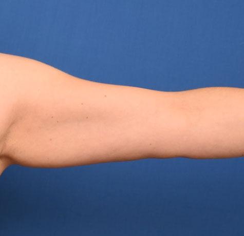 Arm Lift before at Neal Goldberg, MD in Scarsdale, NY
