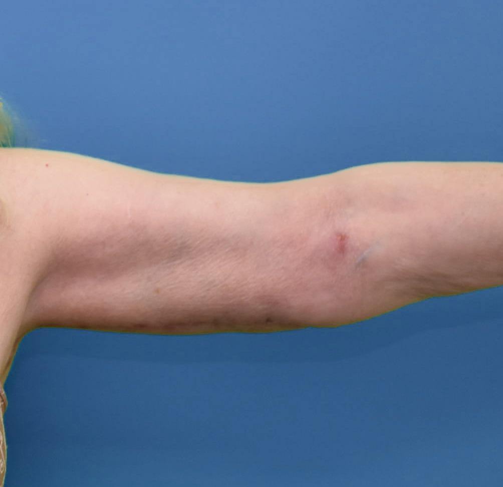 Neal Goldberg, MD arm lift after — Scarsdale, NY